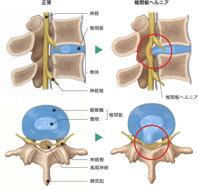 椎間板ヘルニアの予防法３つ｜守口市サンテ鍼灸整骨院