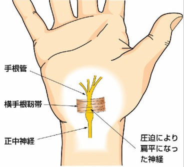 手根管症候群を解説｜守口市｜サンテ鍼灸整骨院